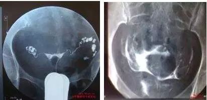 碘佛醇与碘海醇的区别